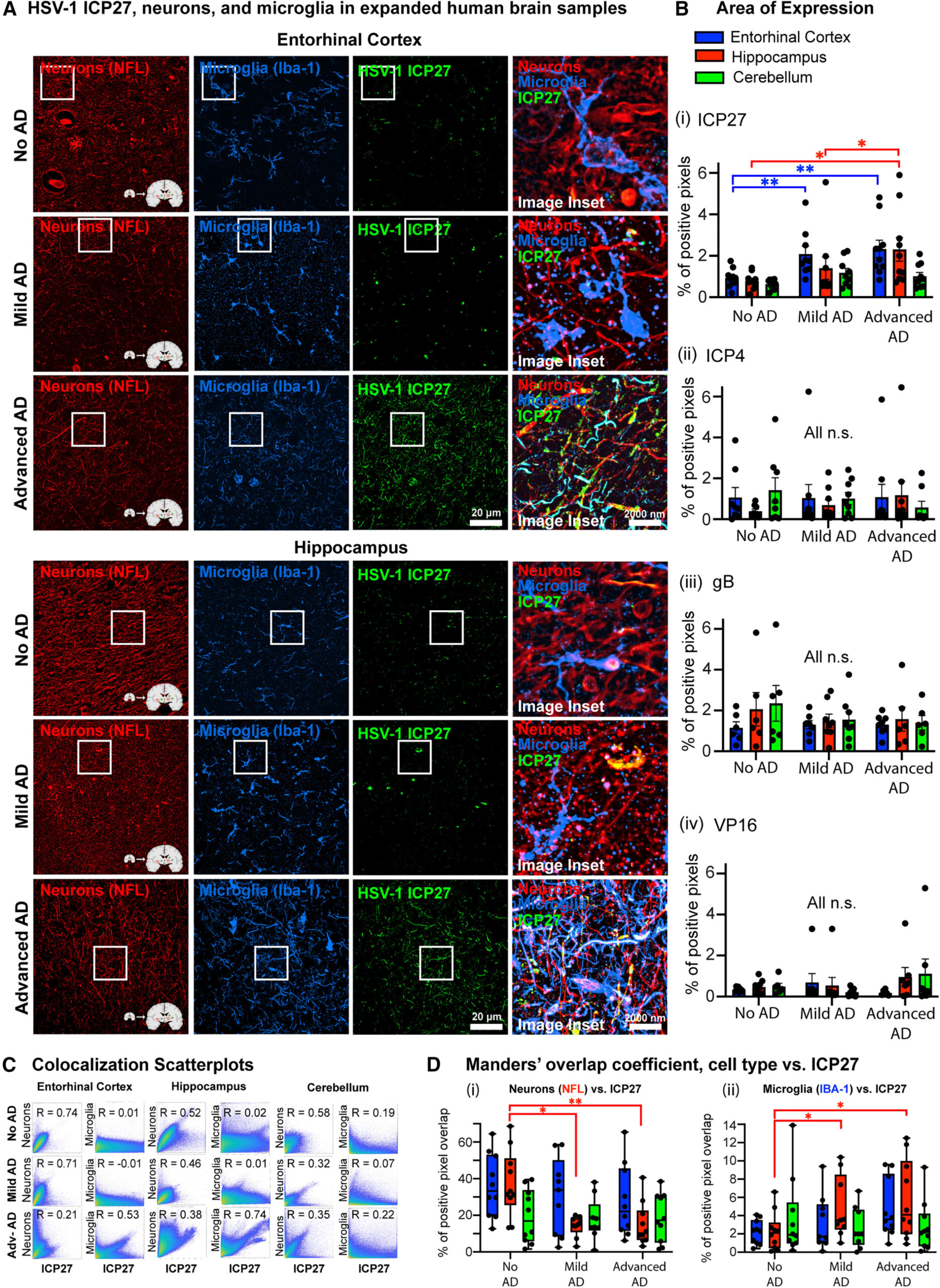 Study Reveals Potential Role of Herpes Virus in Alzheimer’s Disease