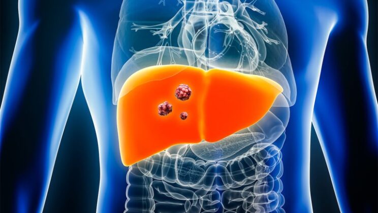 Statins Significantly Reduce Liver Cancer and Complications in Chronic Liver Disease, Study Finds