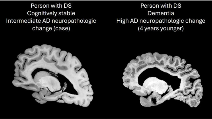 Down Syndrome Study Reveals Surprising Resilience to Alzheimer’s Pathology