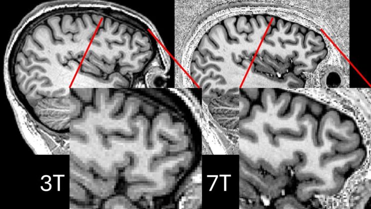 New 7T MRI Technique Reveals Hidden Epilepsy Lesions