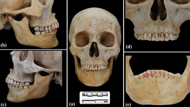 First Case of Cinnabar-Stained Teeth Found in Ancient Burial