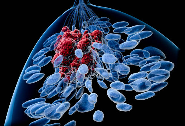 Study Suggests Surgery Not Always Needed for Breast Cancer