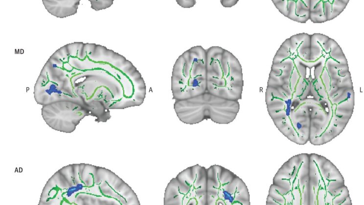 How Midlife Diet and Waistline Shape Brain Health in Later Life
