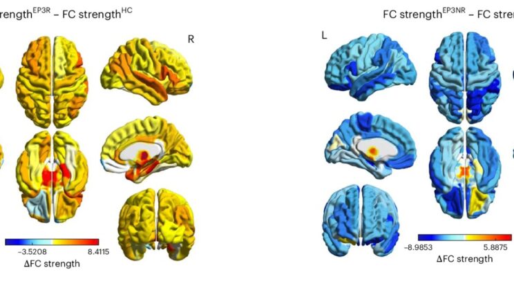 Brain Study Reveals Why Psychosis Sometimes Disappears