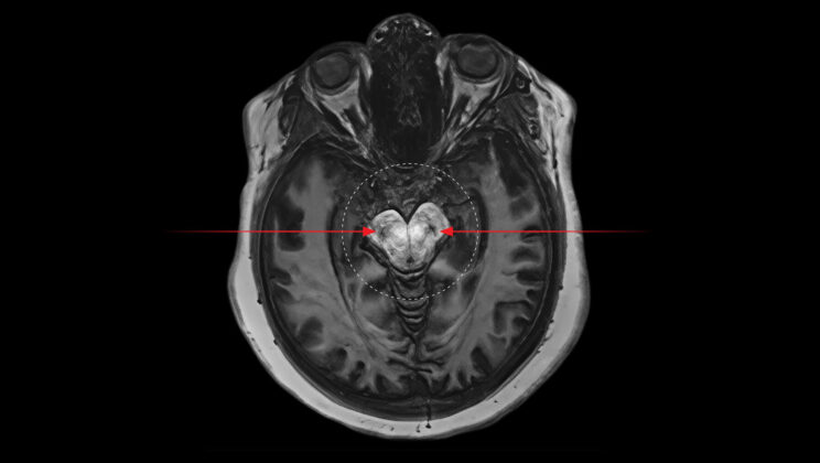 Cannabis Use Linked to Elevated Dopamine Levels and Psychosis Risk