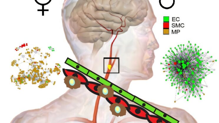 New Study Unveils How Carotid Artery Plaque Differs Between Men and Women—And Why It Matters