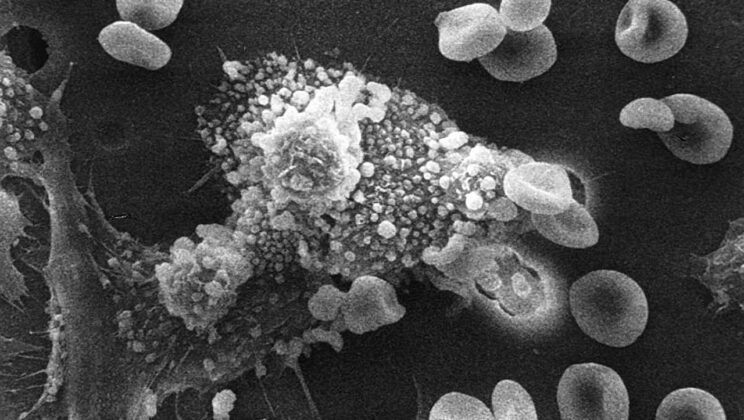 Researchers Discover “Master Switch” to Reprogram Cancer-Supporting Immune Cells