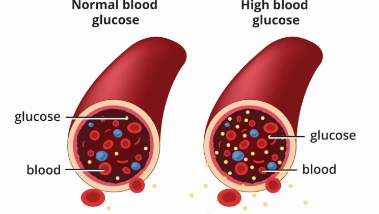 What Is Diabetes? Symptoms, Causes, and Treatment