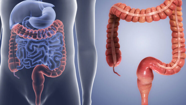 What Is Leaky Gut Syndrome?