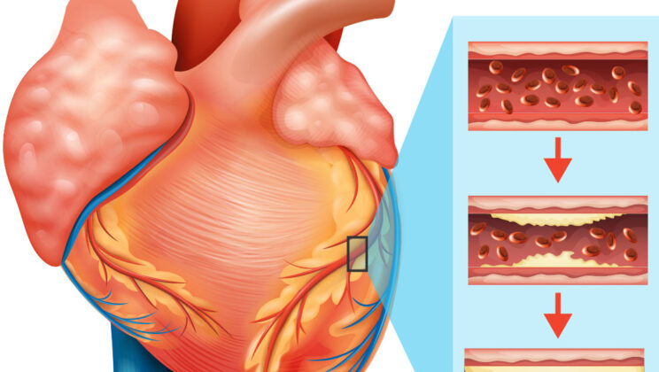 How Heart Disease Develops (And How to Prevent It)