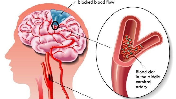 Understanding Stroke: Medical Causes and Recovery