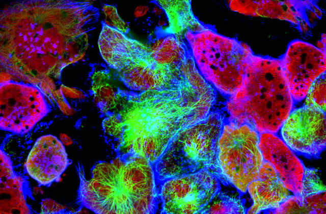 Diabetes Drug Shows Promise in Prostate Cancer Treatment, Study Finds