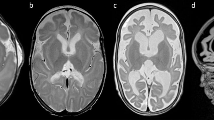 Experimental Genetic Therapy Halts Seizures in Preterm Infant with Rare Epilepsy