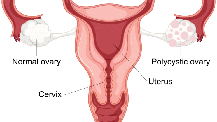 What Is PCOS and How Is It Treated?