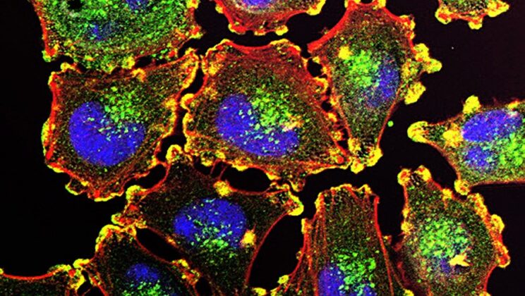 Melanoma’s Hidden Weakness Found in Its Power Supply