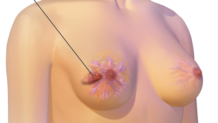 Breast Cancer Explained: Through Science and Stories