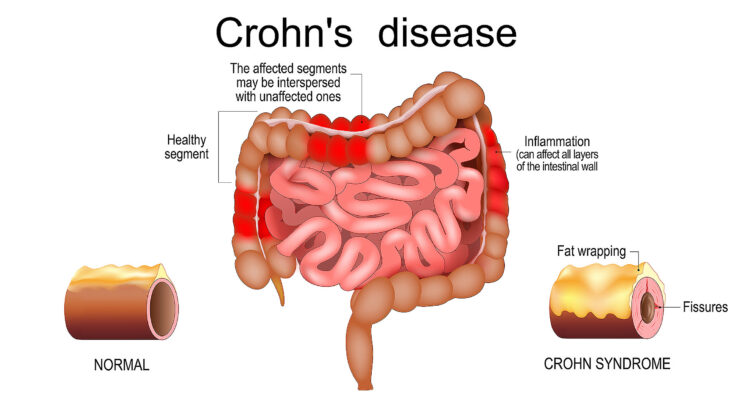 What Is Crohn’s Disease? Understanding Inflammatory Bowel Conditions