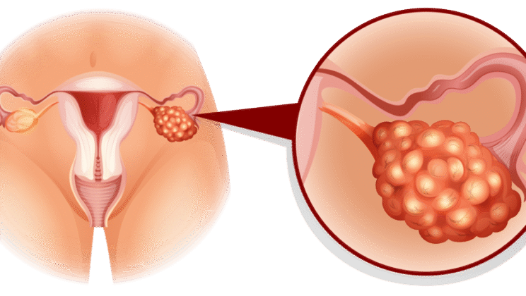 What Is PCOS? A Hormonal Disorder Affecting Millions