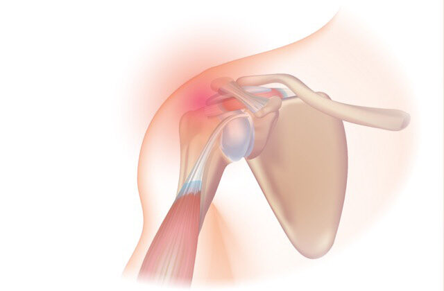 Tendonitis and Bursitis: Common Overuse Injuries
