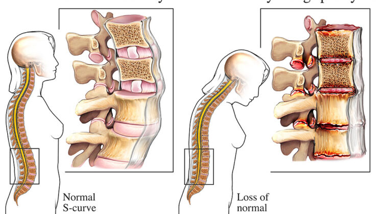 Ankylosing Spondylitis: When Your Spine Stiffens