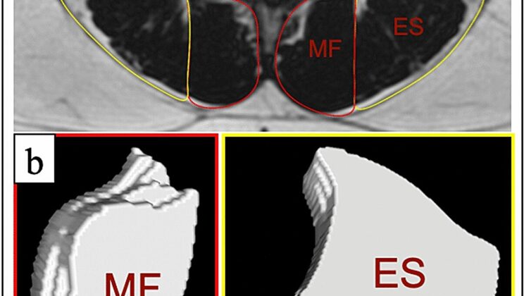 Water Therapy Brings Relief to Chronic Back Pain Sufferers