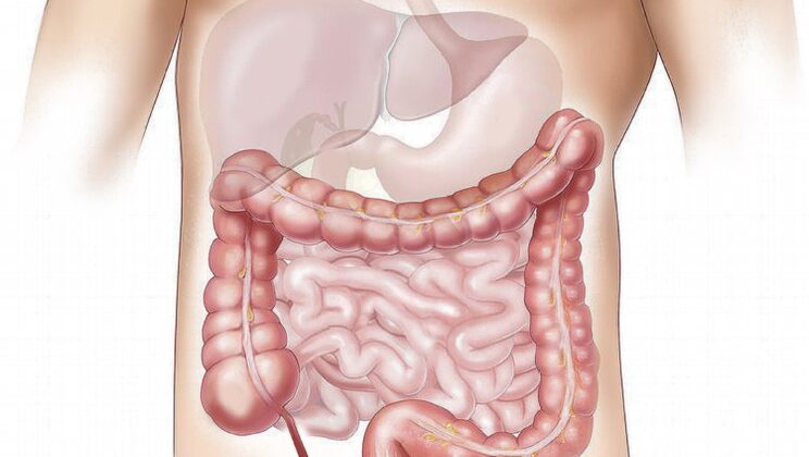 Screening at 45 Shows Strong Results in Colorectal Cancer Prevention