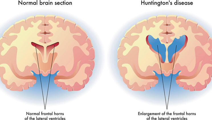 The Science Behind Huntington’s Disease
