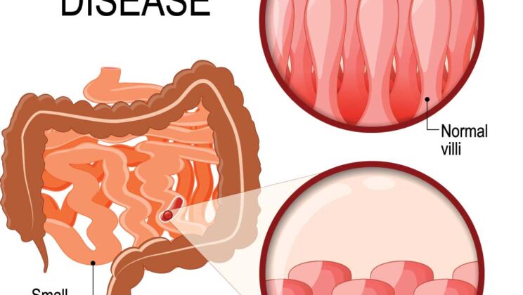 How Celiac Disease Damages the Gut