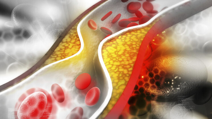 The Role of Cholesterol in Heart Disease