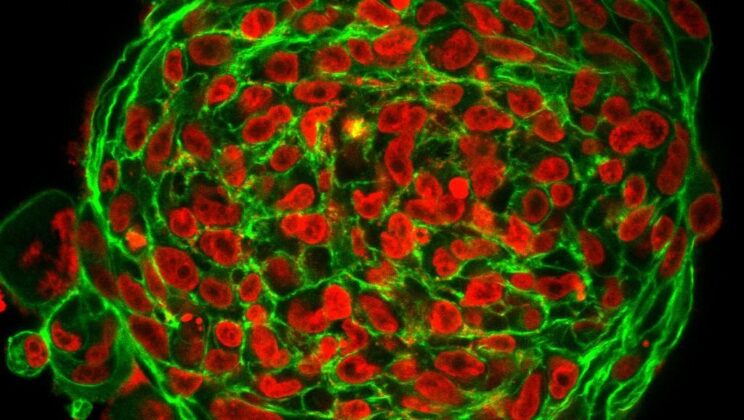 What Causes Cancer? From Genes to Environment