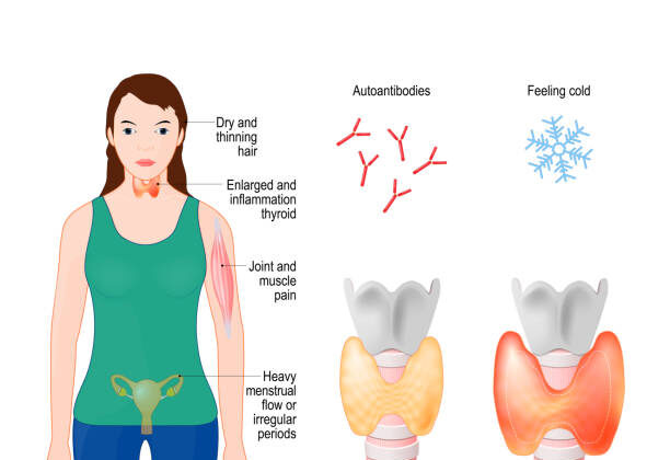 Hashimoto’s Thyroiditis: When Your Immune System Targets Your Thyroid