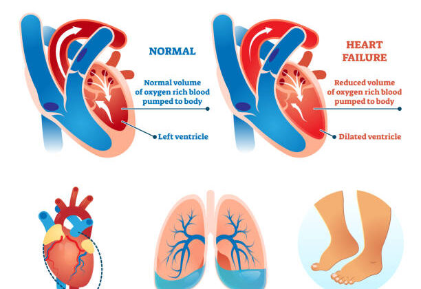 What Is Congestive Heart Failure?