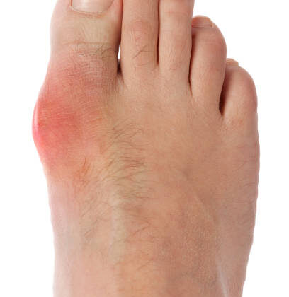What Causes Gout and How to Manage It