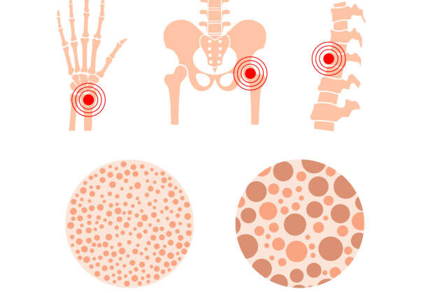 What Is Osteoporosis? How Bones Become Fragile
