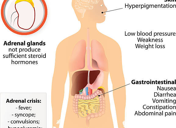 Adrenal Fatigue: Myth or Medical Condition?