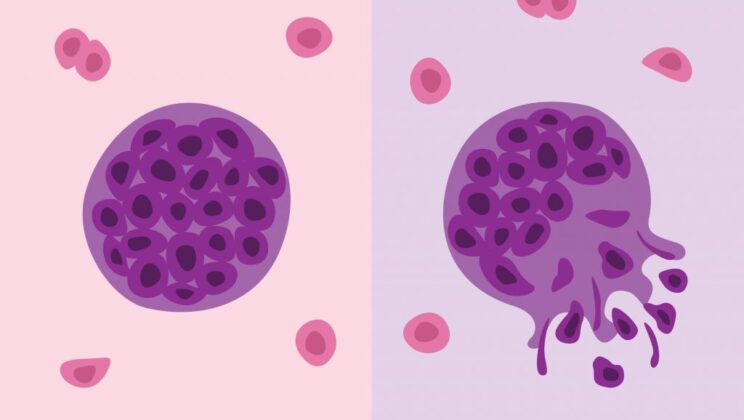The Difference Between Benign and Malignant Tumors