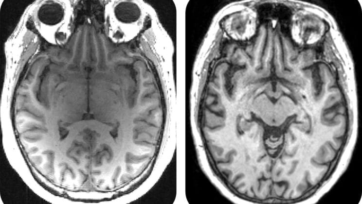 The AI That Gave a Failed Alzheimer’s Drug a Second Chance