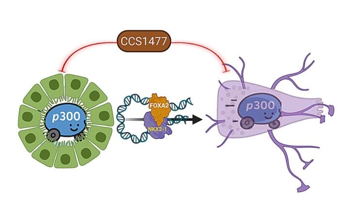 Scientists Uncover How Prostate Cancer Becomes Its Deadliest Form and How to Stop It