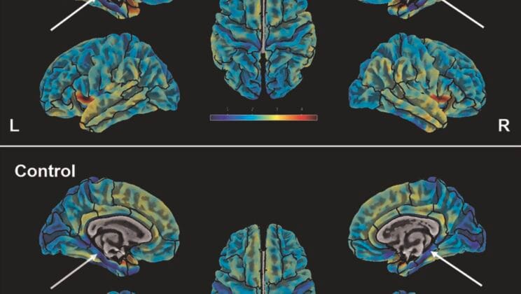 Scientists Discover Hidden Brain Signature That May Reveal the Roots of Depression