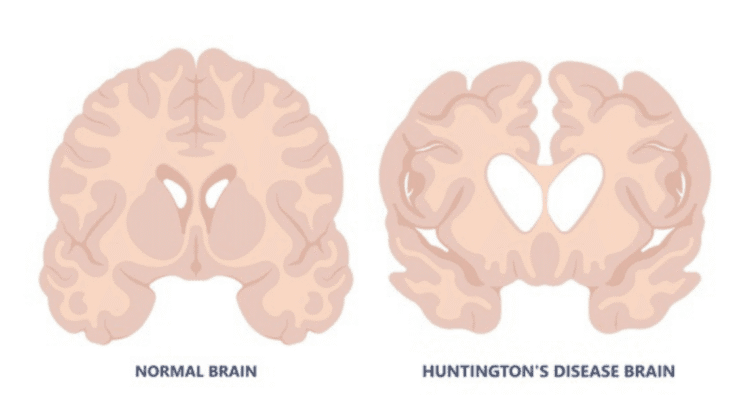 Huntington’s Disease: Causes, Symptoms, Diagnosis, and Treatment