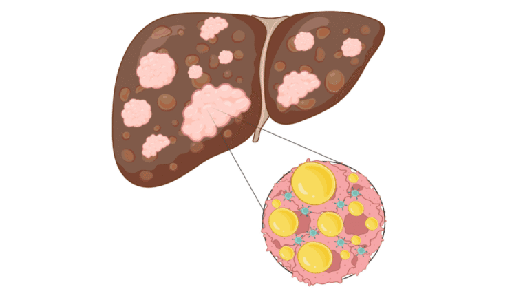 Scientists Discover How to Starve Liver Cancer by Cutting Off Its Fat Supply
