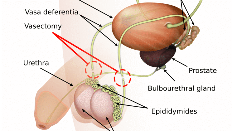Thinking About Vasectomy? What Men Should Know About Permanent Birth Control