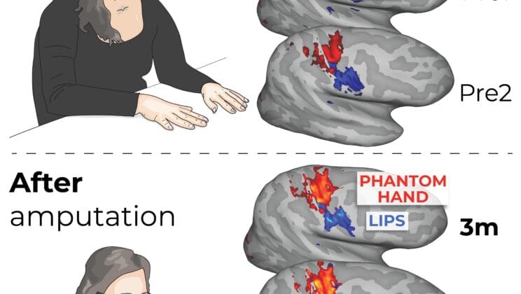 The Brain Remembers Limbs That Are No Longer There