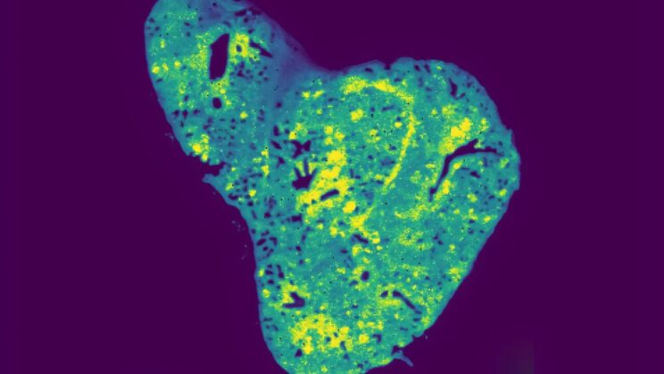 Scientists Uncover How a Hidden Force Inside Cells Drives Cancer’s Spread