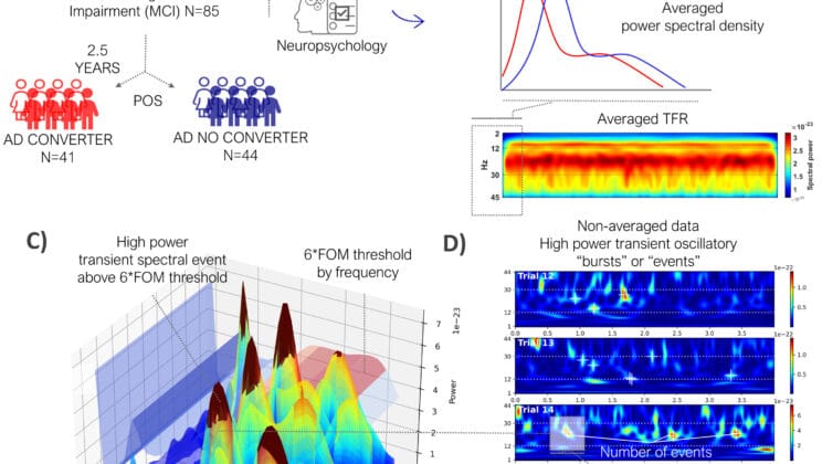 New Brain Signal Could Predict Alzheimer’s Years Before Diagnosis, Study Finds