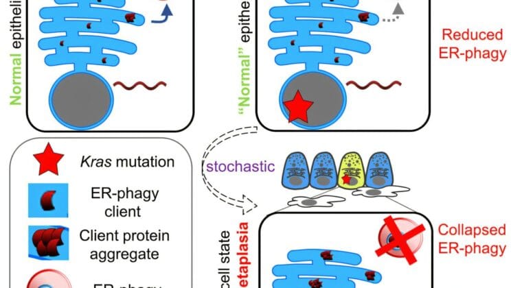 Pancreatic Cancer May Begin With Cells That Behave Like They Have Dementia