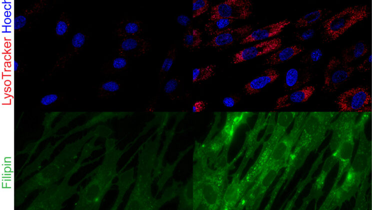 Scientists Crack Genetic Code Behind Mysterious Childhood Disease Bringing Families New Hope
