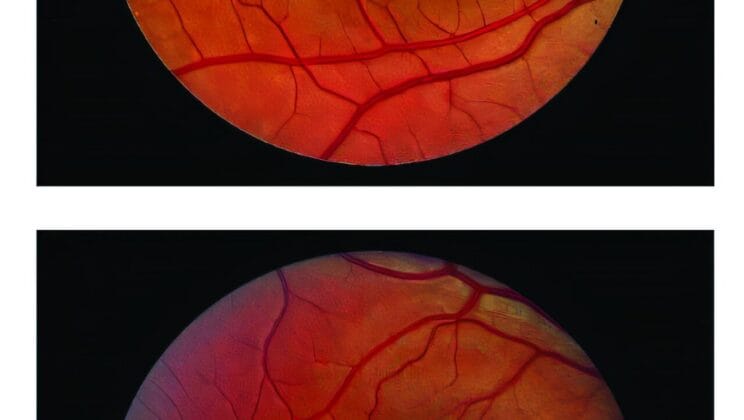 Tiny Eye Implant Slows Vision Loss and Changes the Future of Sight