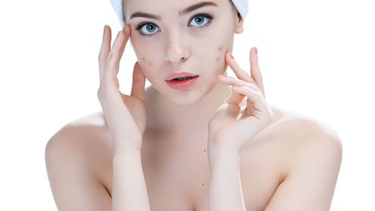 Acne: Causes, Symptoms, Diagnosis, and Treatment