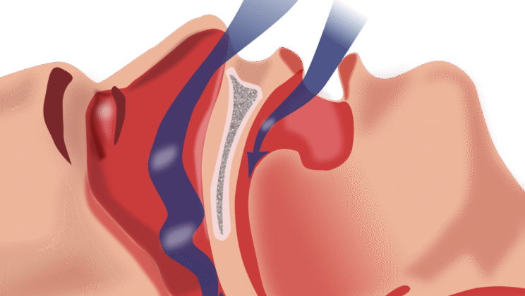 Sleep Apnea: Causes, Symptoms, Diagnosis, and Treatment